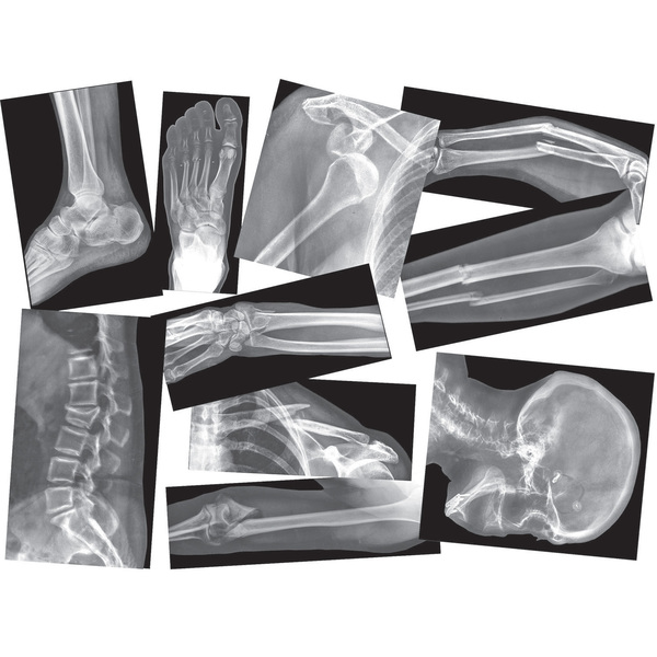 Roylco Broken Bones X-Ray Set, 15 Pieces R5914